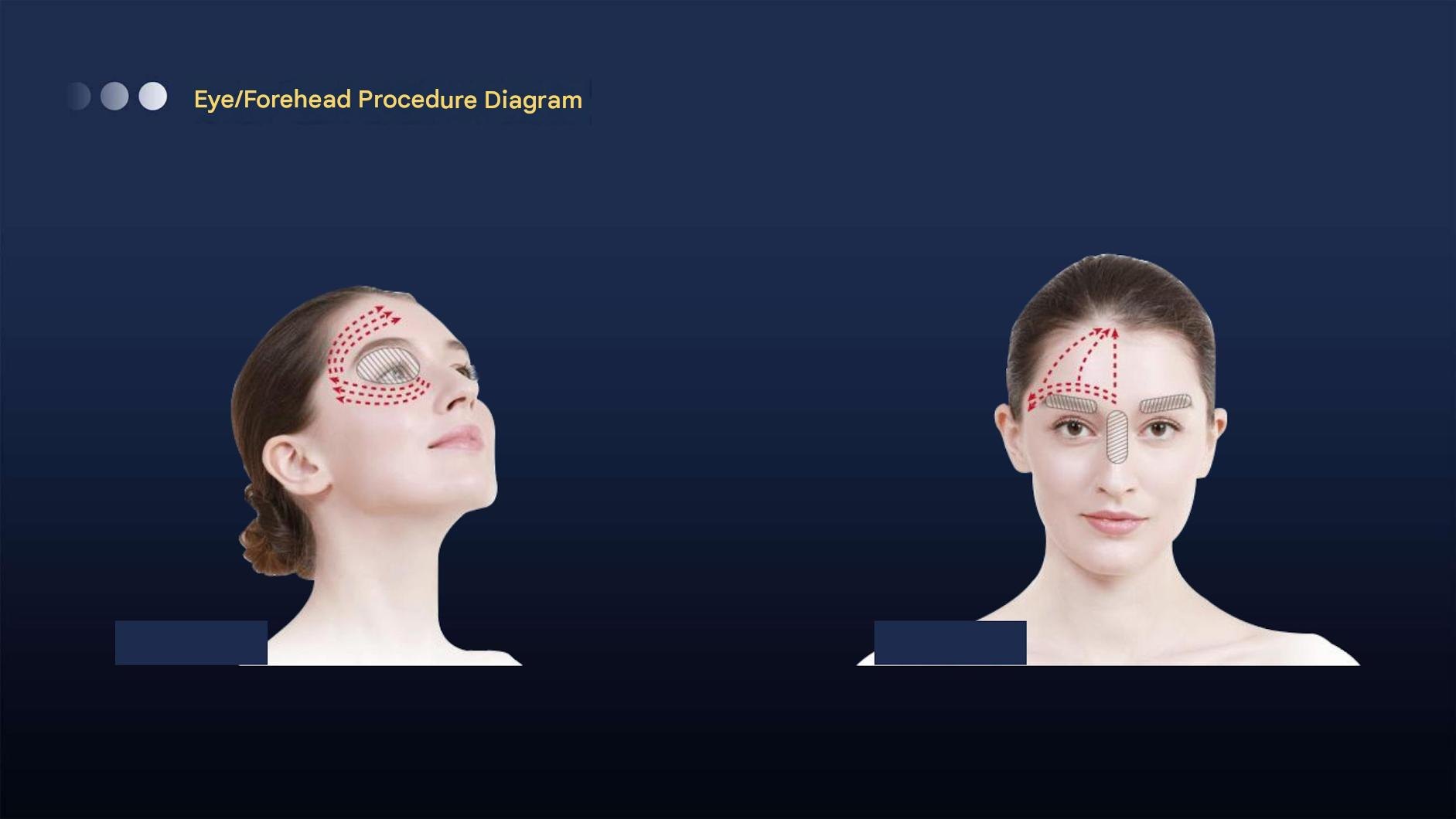 Diagram of treatment lines for the eye area and forehead