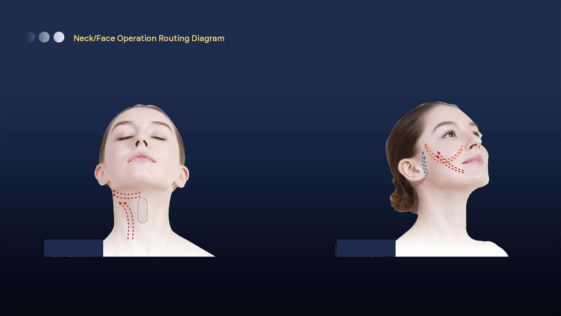 Diagram of treatment lines for face and neck